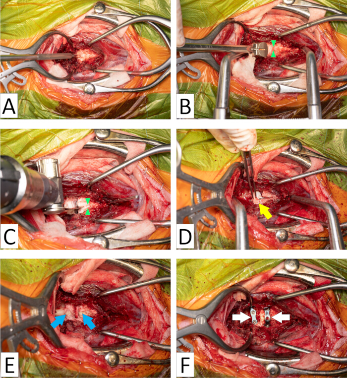 Spinal surgery step-by-step, illustrating incision, retraction, and implant placement processes.