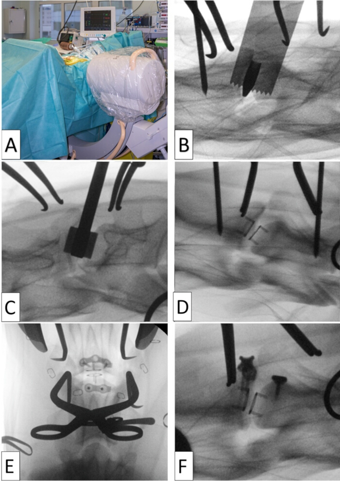 Surgical procedure and fluoroscopy images of spinal hardware placement; medical intervention analysis.