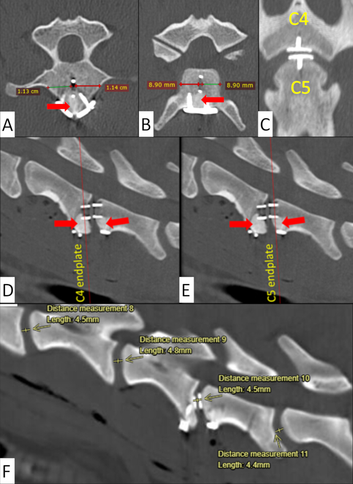 Cervical spine CT scan showing vertebra alignment and distance measurements for structural analysis.