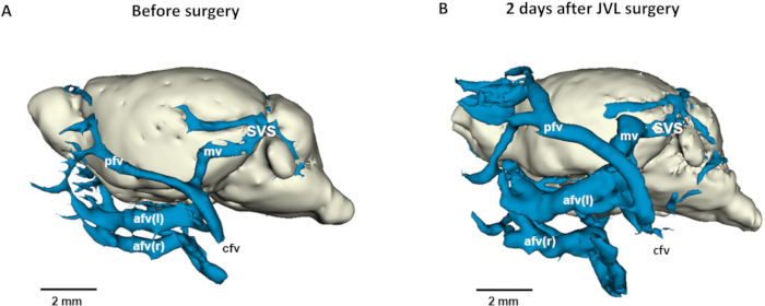 figure-results-4 3D brain vein structure visualization; pre and post-surgery comparison; anatomical changes.