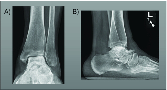 Dual X-ray images of human ankle; frontal and lateral views for fracture assessment.