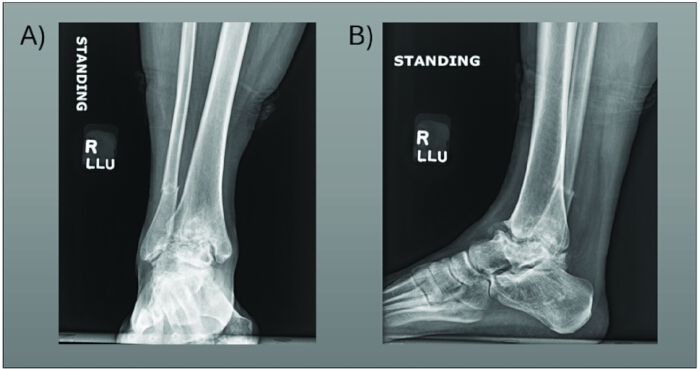 Ankle X-ray diagram, frontal and lateral views, for orthopedic analysis.