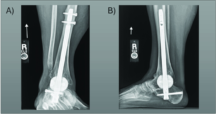Intramedullary nail fixation; X-ray images; orthopedic procedure; fracture stabilization; side views.