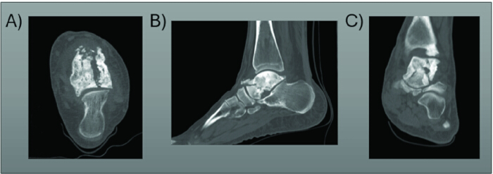 MRI scans of foot anatomy, displaying transverse, lateral, and axial views for diagnostic analysis.