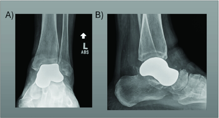 X-ray analysis; ankle prosthesis placement; two angles; orthopedic surgery result; medical imaging.