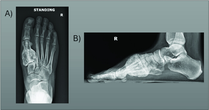 X-ray foot images, frontal and lateral views, showing bone structure for medical analysis.