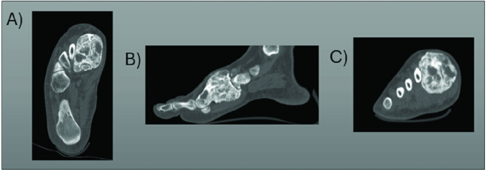 CT scan showing foot bones; three views: axial, sagittal, and coronal. Radiology examination.