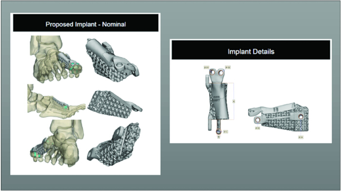 Medical implant design process; 3D model diagram with structural details and proposed configurations.