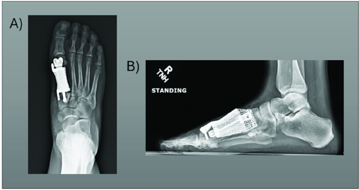 X-ray showing foot implants post-surgery; A) dorsal view, B) lateral view; medical analysis.
