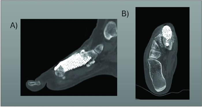 CT scan images showing bone grafts in an orthopedic procedure; axial and sagittal views.