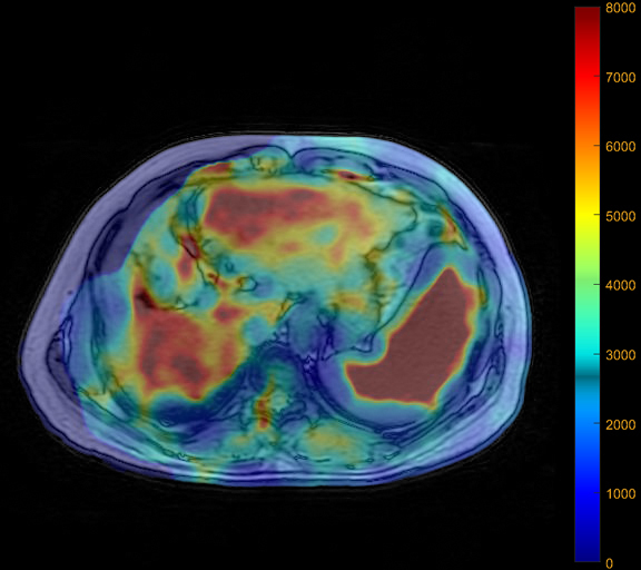PET scan diagram with color scale for metabolic activity analysis in brain imaging studies.