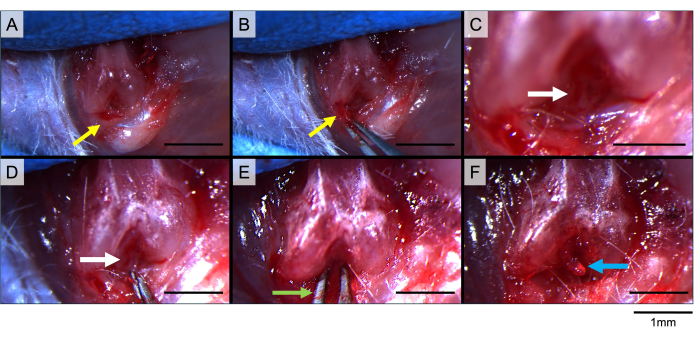 Microsurgery sequence; tissue dissection method; labeled diagram for surgical technique study.