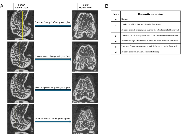 Femur growth plate CT scans, osteoarthritis severity table; diagram analyzing bone morphology and OA risk.