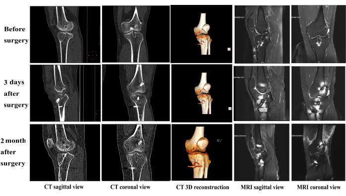 Knee surgery progress, CT/MRI diagnostic imaging, sagittal/coronal views, CT 3D reconstruction.