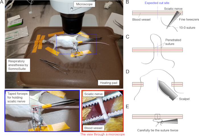 Sciatic nerve suture diagram; procedure includes forceps, microscope, scalpel; surgical method.