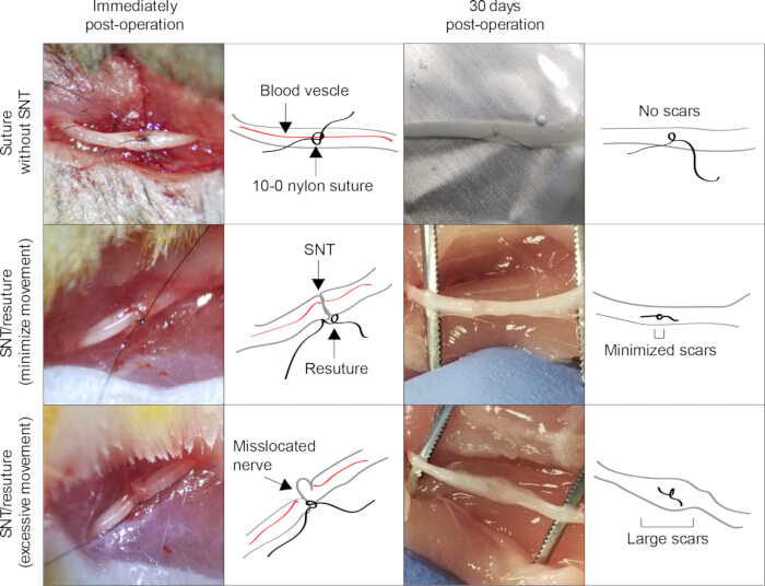 Surgical nerve transfer (SNT); sutures, healing diagram; minimize vs. excessive movement scars.