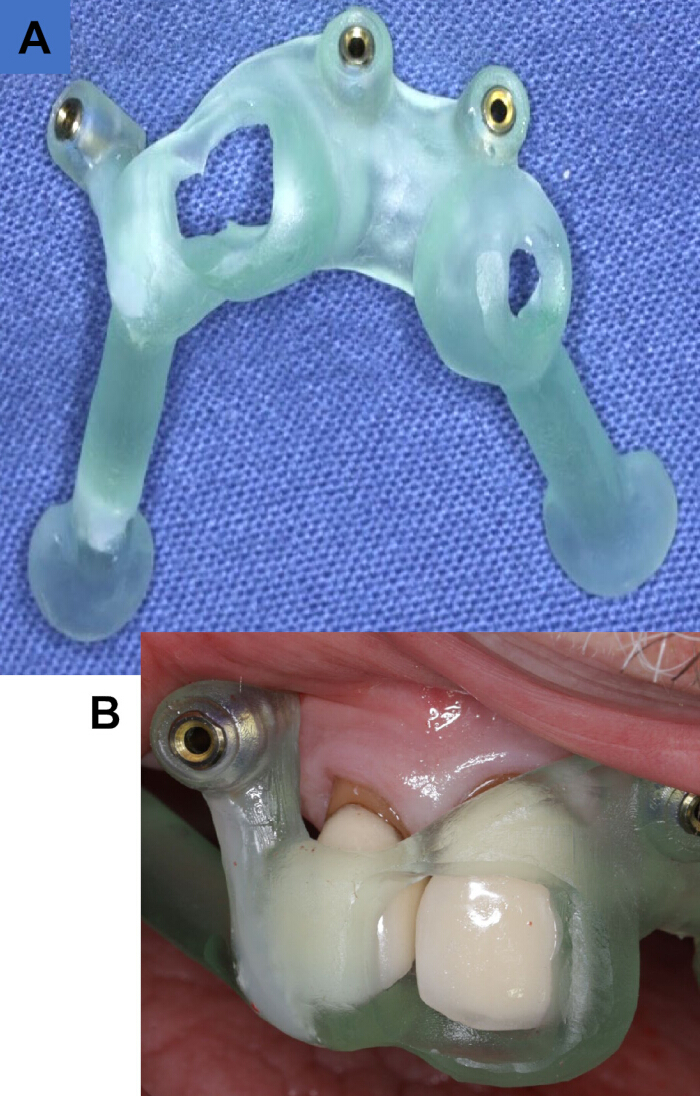 figure-results-1 Dental implant guide placement; diagram showing plastic guide and implant fitting in a patient's mouth.