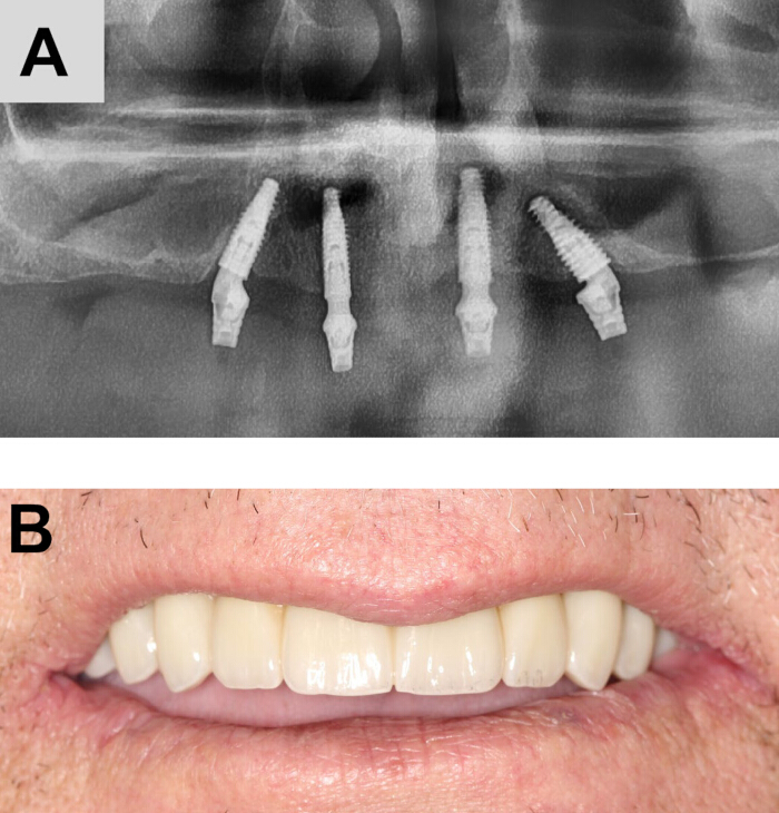 figure-results-9 Dental implant diagram and result; X-ray and prosthetic teeth post-insertion.