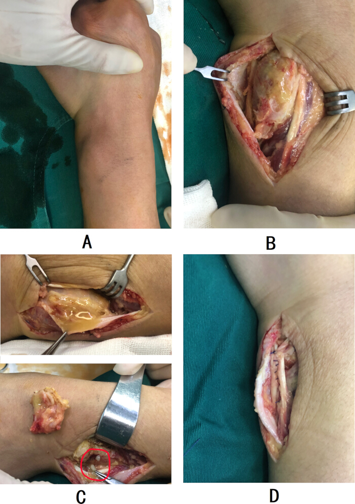 figure-results-11 Surgical process of olecranon bone exposure; sequence of elbow dissection; medical procedure.