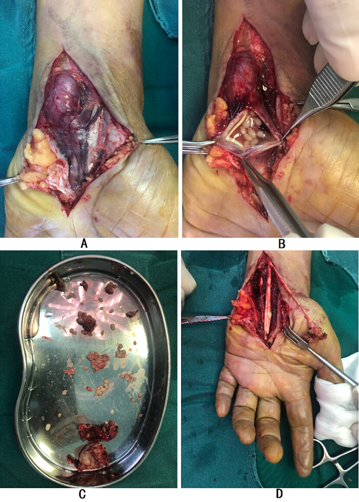 figure-results-2 Surgical debridement procedure for hand necrosis with removal of necrotic tissue and visualization of tendons.