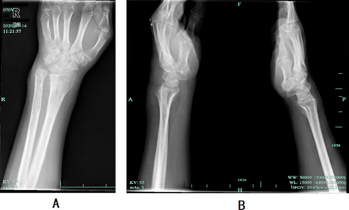 figure-results-5 X-ray of forearm fractures; two angles showing a broken radius and ulna, for medical analysis.