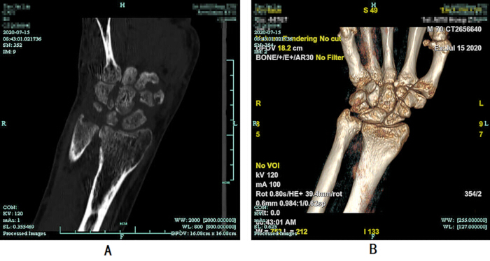figure-results-6 CT scan images of wrist anatomy; cross-sectional view and 3D rendering for fracture assessment.