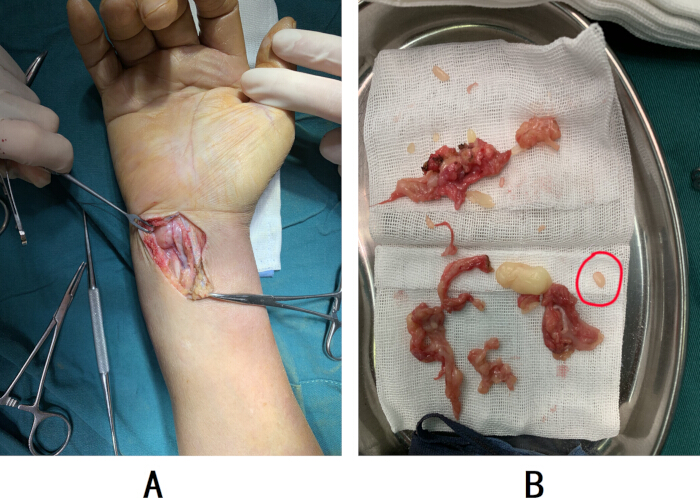 figure-results-7 Surgical procedure on hand for cyst removal, dissected tissue shown; medical education reference.
