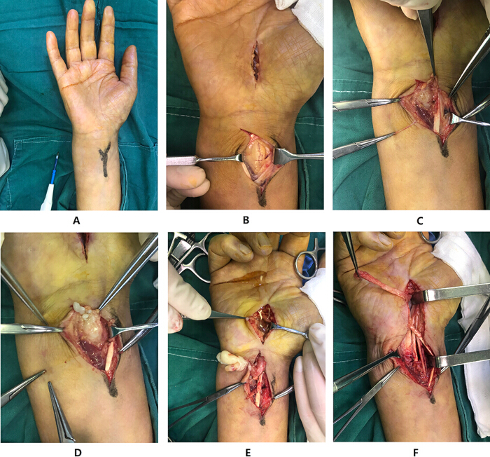 figure-results-9 Surgical procedure sequence; wrist incision and exploration; orthopedic operation; clinical method.