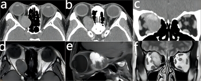CT and MRI scans of orbital cavities, showing anatomical structure and possible abnormalities.