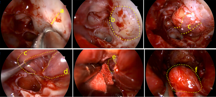 Endoscopic neurosurgery process; annotated steps; surgical site; brain tissue visualization.