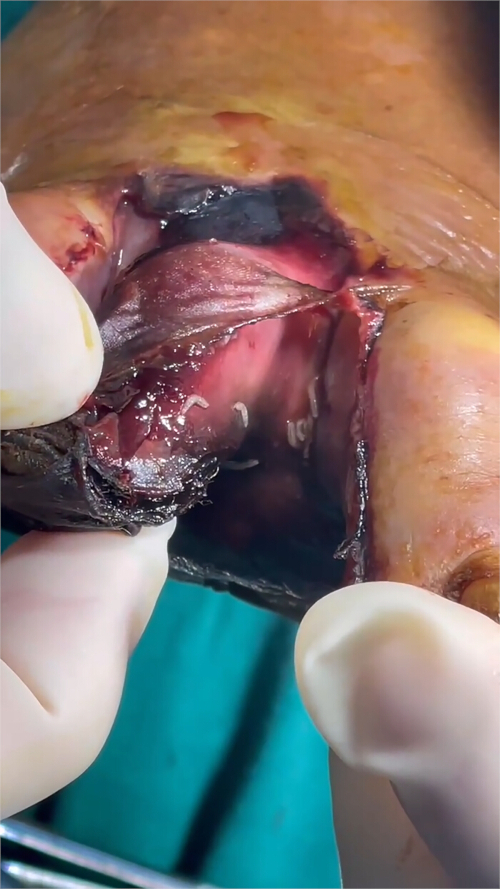 Surgical site showing sutured wound and tissue analysis, potentially for medical study or procedure.
