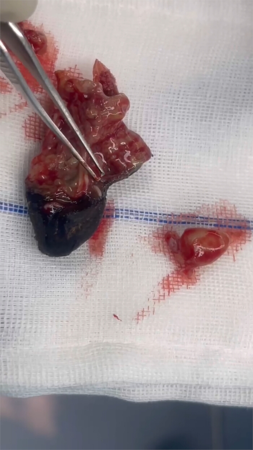 Tissue dissection with tweezers on gauze for medical or biological research analysis.