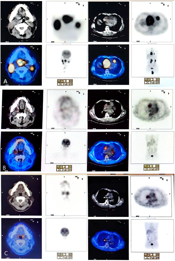 PET/CT scan images, diagnostic imaging analysis, cross-sectional views, medical imaging results.