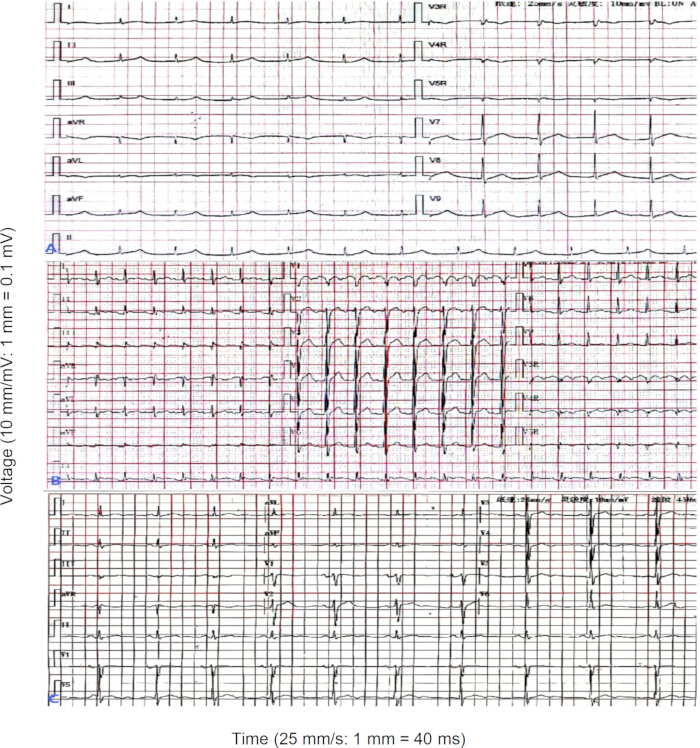 ECG waveform chart displaying heart electrical activity analysis.