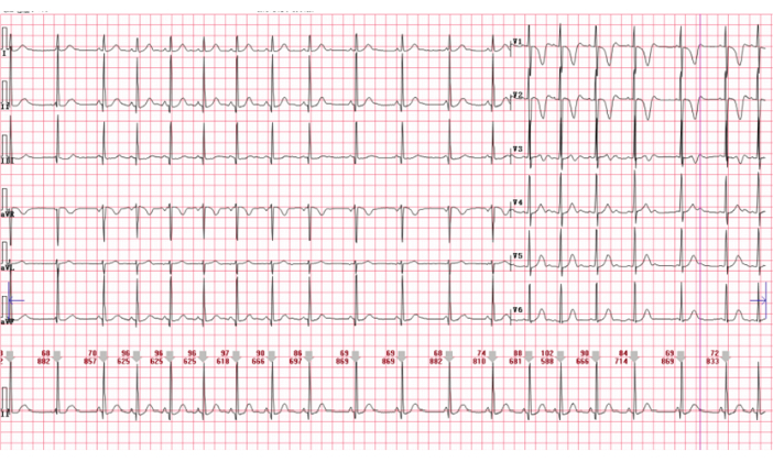 ECG graph showing cardiac electrical activity; diagnostic tool for heart rhythm and function analysis.