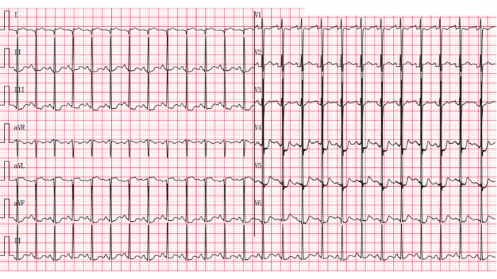 Electrocardiogram (ECG) results; diagram showing heart electrical activity for rhythm analysis.
