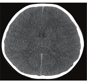 CT scan revealing cross-sectional brain image; diagnostic imaging; axial view; medical analysis.