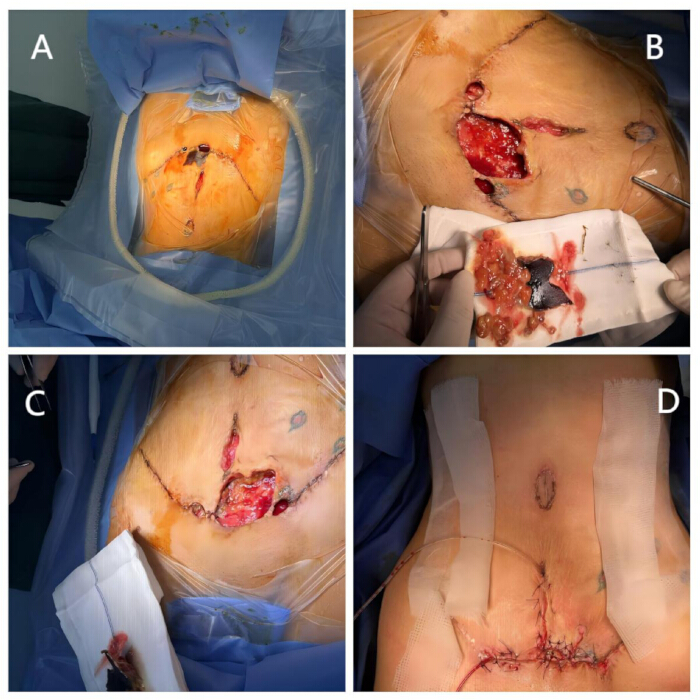 Surgical procedure sequence on abdominal area for tumor removal, post-operative closure details.
