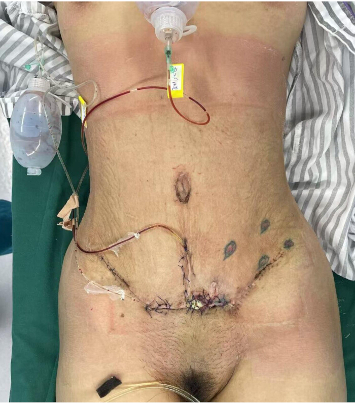 Post-surgical abdominal drainage setup, featuring surgical sutures and drainage tubes.