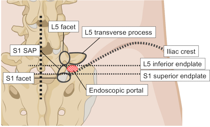 Diagram of spinal anatomy, L5-S1 vertebrae, endoscopic portal.
