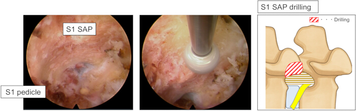 S1 SAP drilling process, endoscopic view, diagram with S1 pedicle, spinal surgical procedure.
