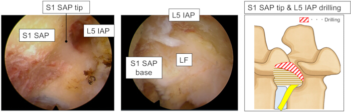 S1 SAP tip, L5 IAP anatomy; endoscopic surgical view and drilling diagram for spinal decompression.