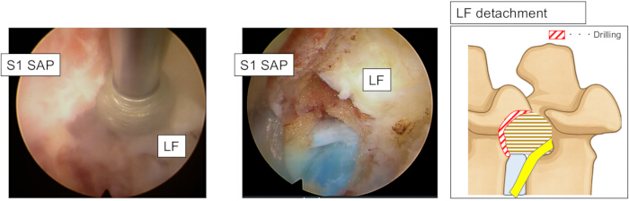 LF detachment diagram and endoscopic images showing S1 SAP drilling process in spinal anatomy study.