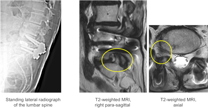 Lumbar spine imaging: lateral radiograph, T2-weighted MRI para-sagittal and axial views, diagnosis.