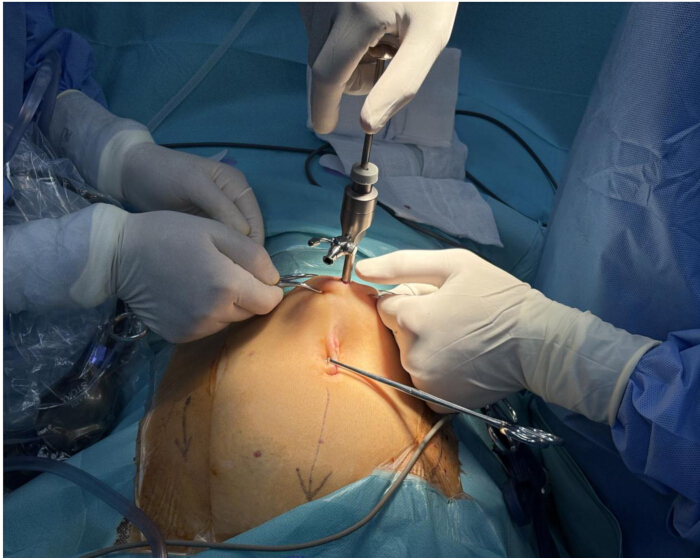 Surgical procedure, spine stabilization, operating room, medical equipment, orthopedic surgery.