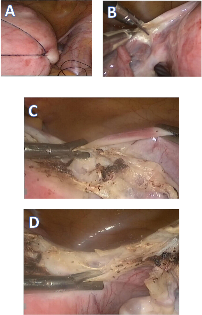 Laparoscopic surgery images showing suturing techniques and tissue dissections in procedural steps.