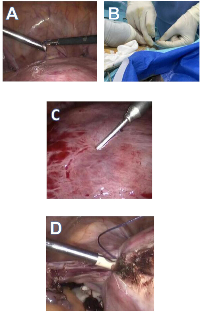 Laparoscopic surgery steps; tools in use; minimally invasive procedure; medical technique.