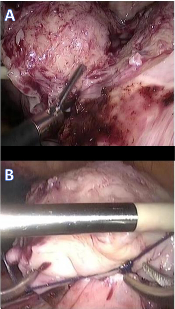 Laparoscopic inguinal hernia repair, surgical procedure, images A and B, medical education.