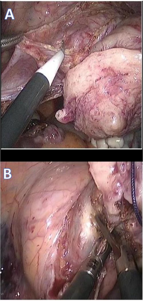 Laparoscopic surgery technique with electrocautery in visceral dissection image for medical study.