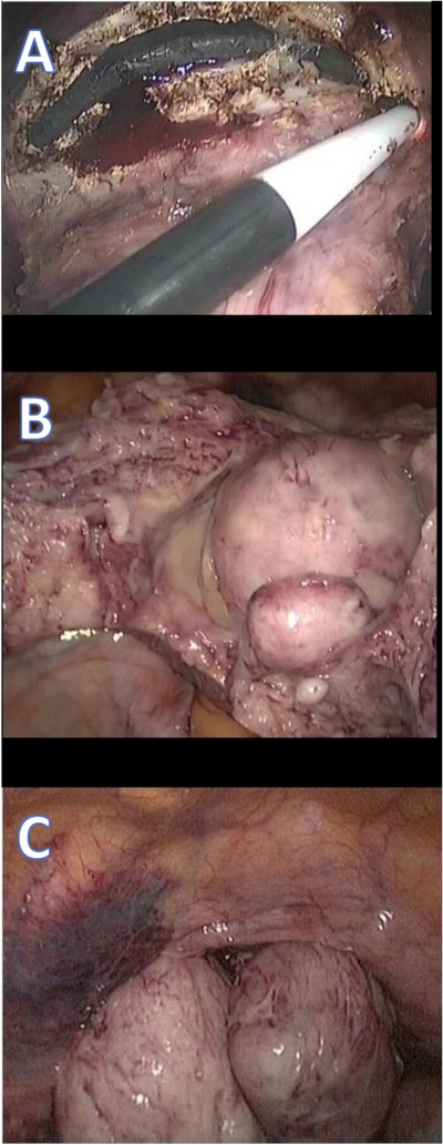 Surgical procedure images showing tissue inspection and manipulation in medical examination.